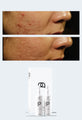 Prescription Medical Grade Reverse Skin Scarring Skincare Treatment