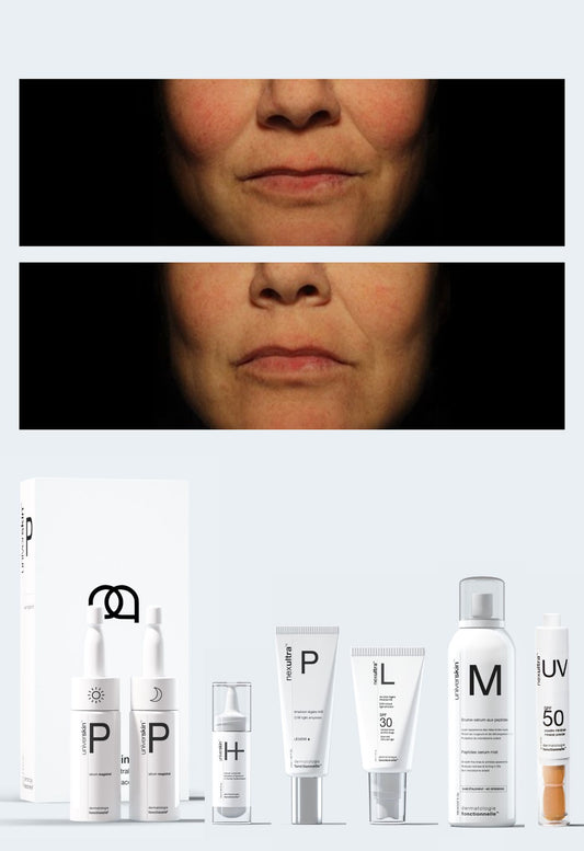Personalised Medical Grade Prescription Skincare Treatment for Thread Veins complete package
