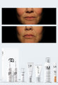 Personalised Medical Grade Prescription Skincare Treatment for Thread Veins complete package
