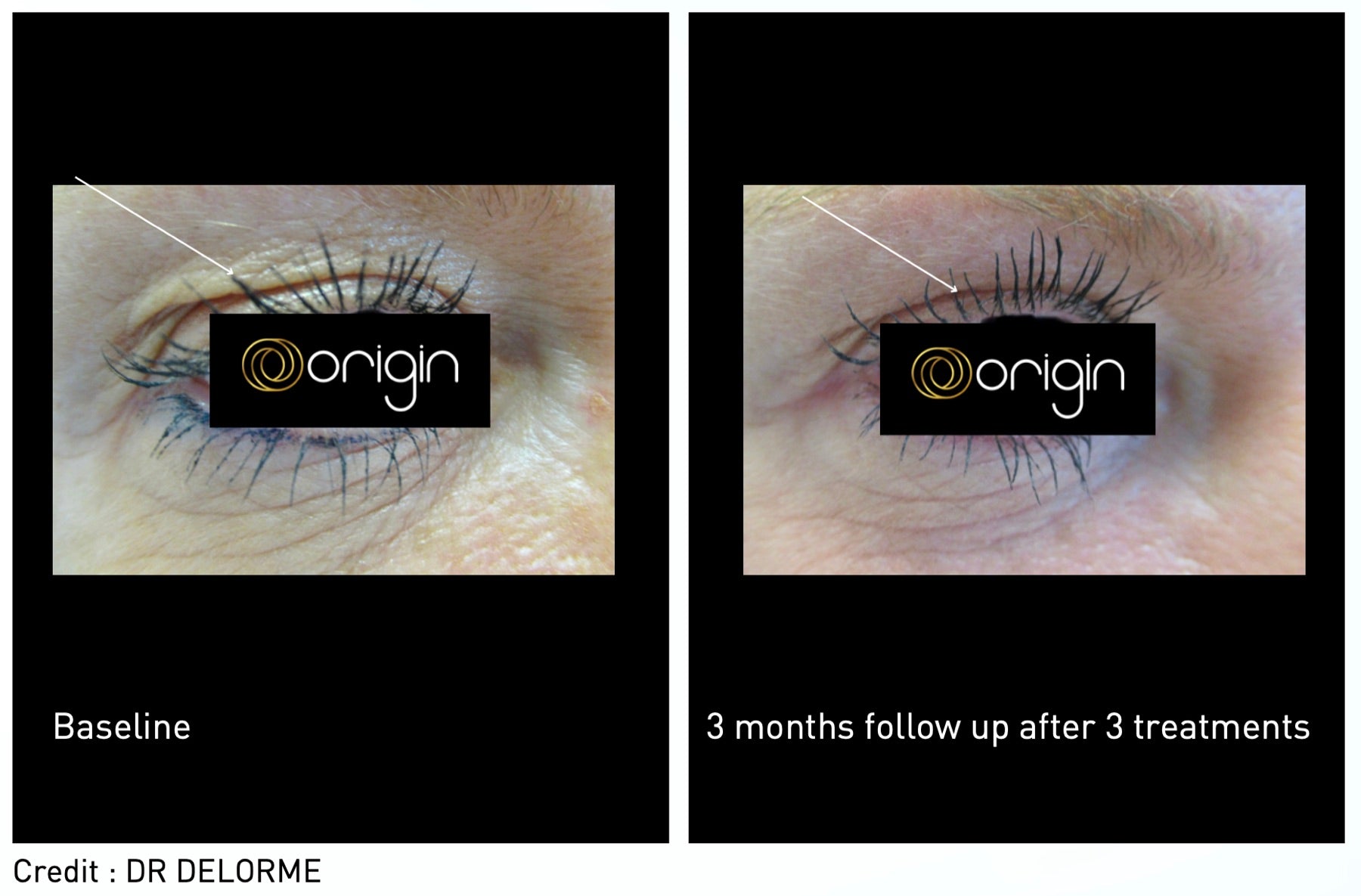 Origin Glass Laser non-surgical blepharoplasty before and after upper eyelid and eye-area renewal.