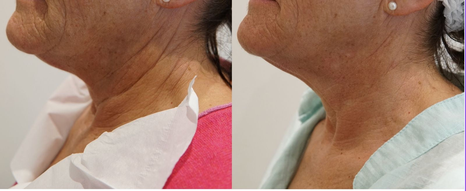 Origin Glass Laser neck rejuvenation before and after skin quality result.