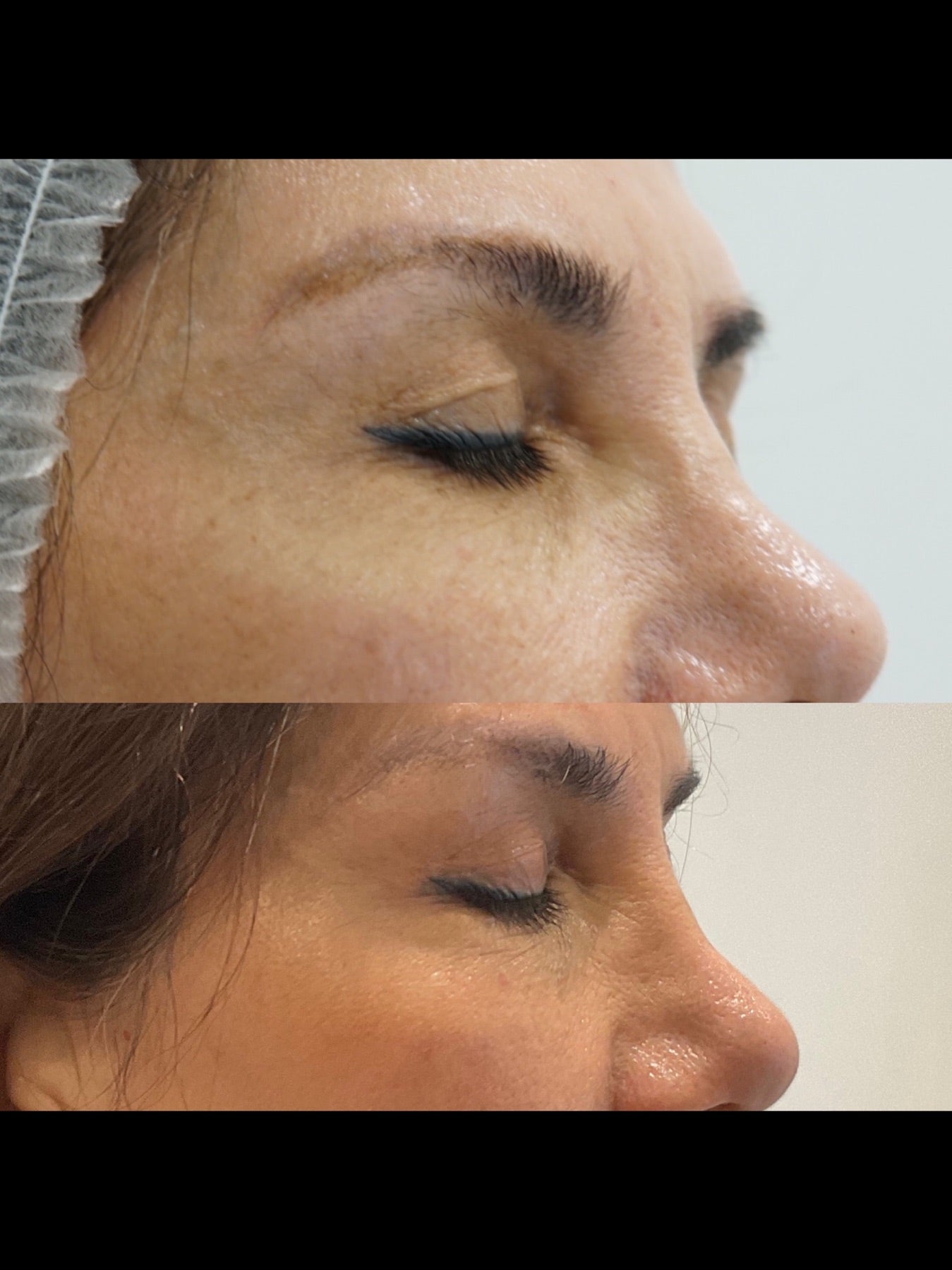 Origin Glass Laser non-surgical blepharoplasty before and after Day 30 eye-area result one.