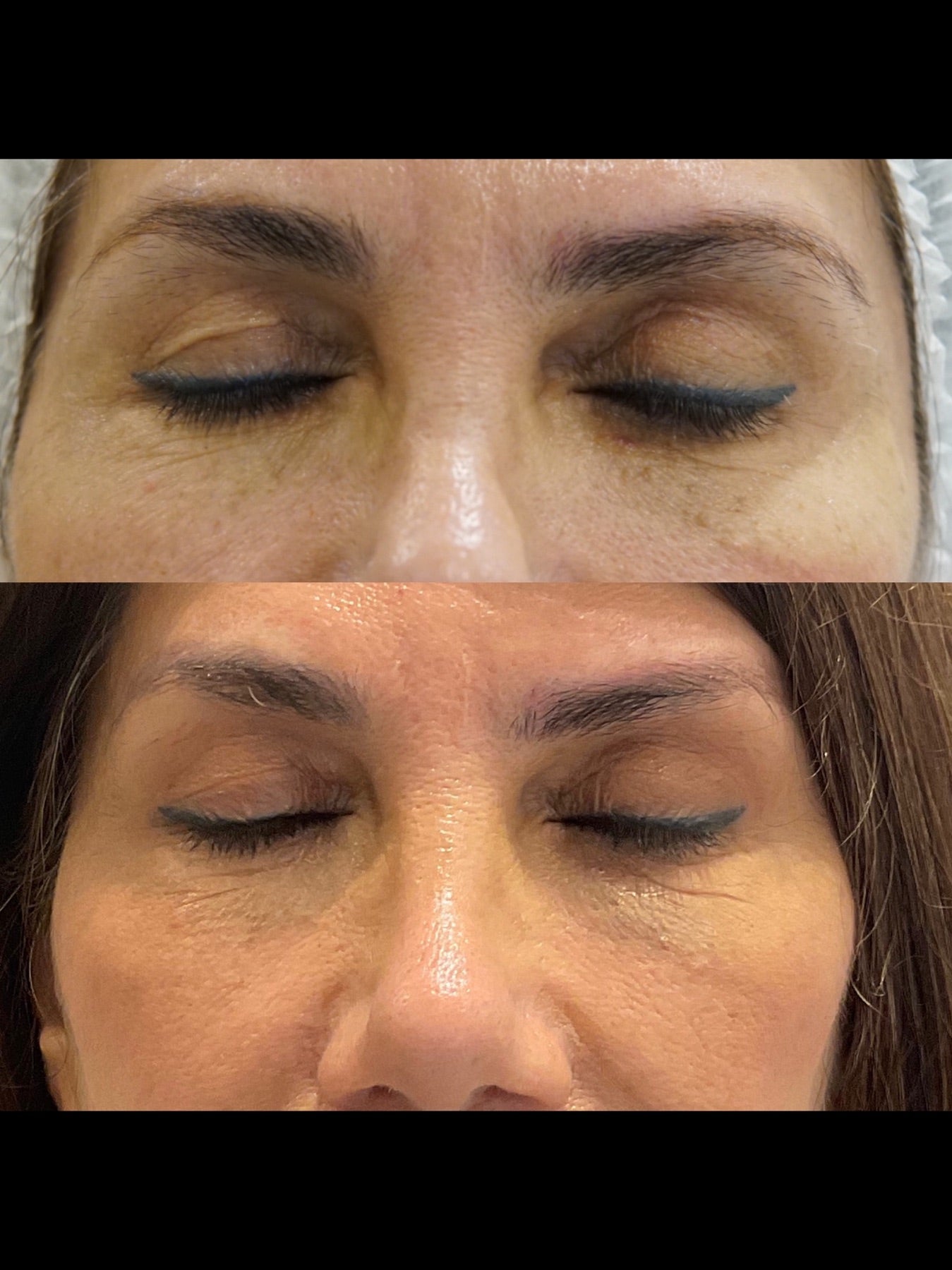 Origin Glass Laser non-surgical blepharoplasty before and after Day 30 eye-area result two.