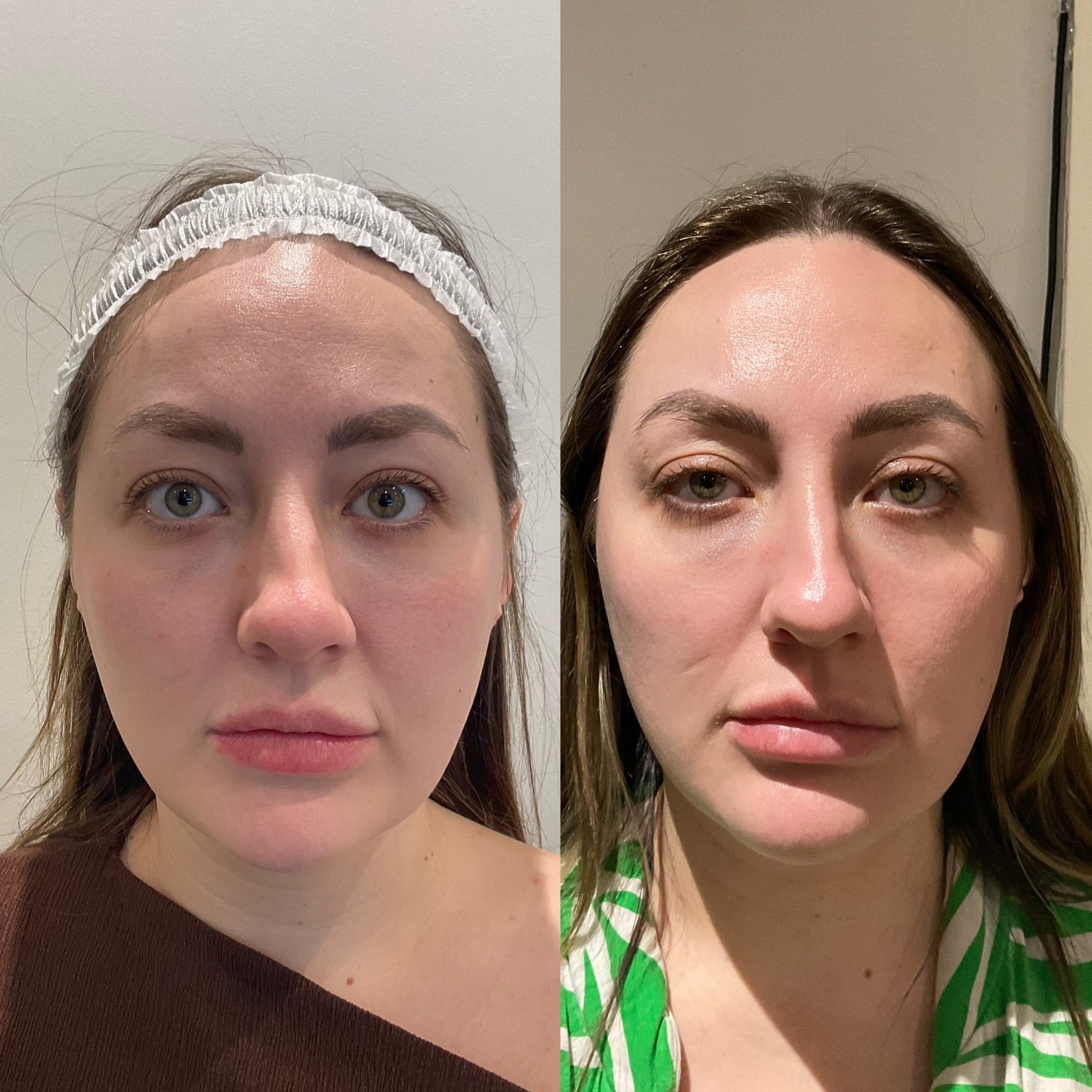 Dr Sknn skin texture and pores before and after proof image