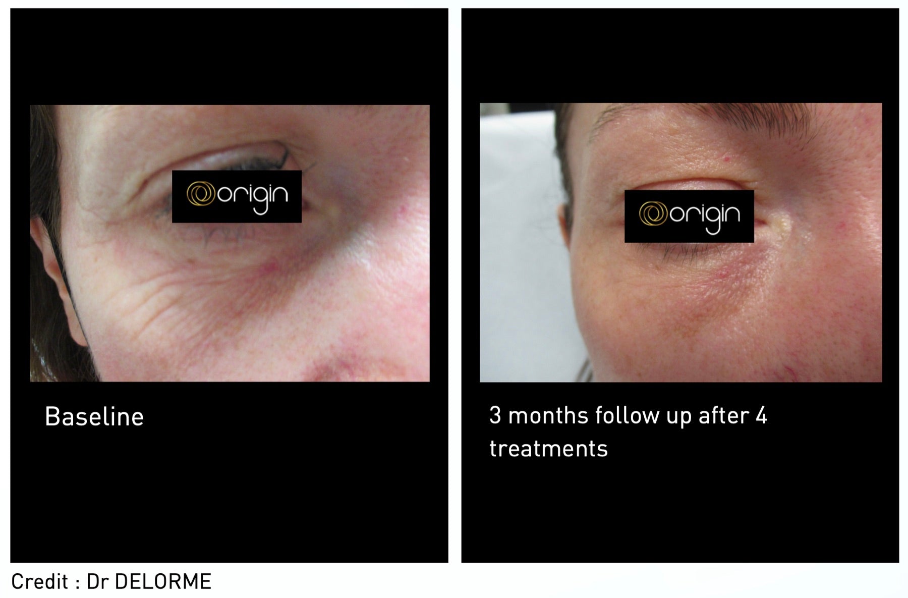 Origin Glass Laser skin rejuvenation before and after casebook result.