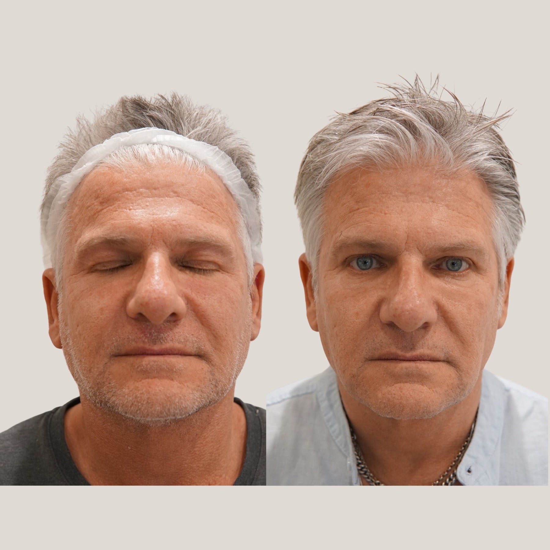 Origin Glass Laser Day 0 to Day 30 full-face front rejuvenation comparison.