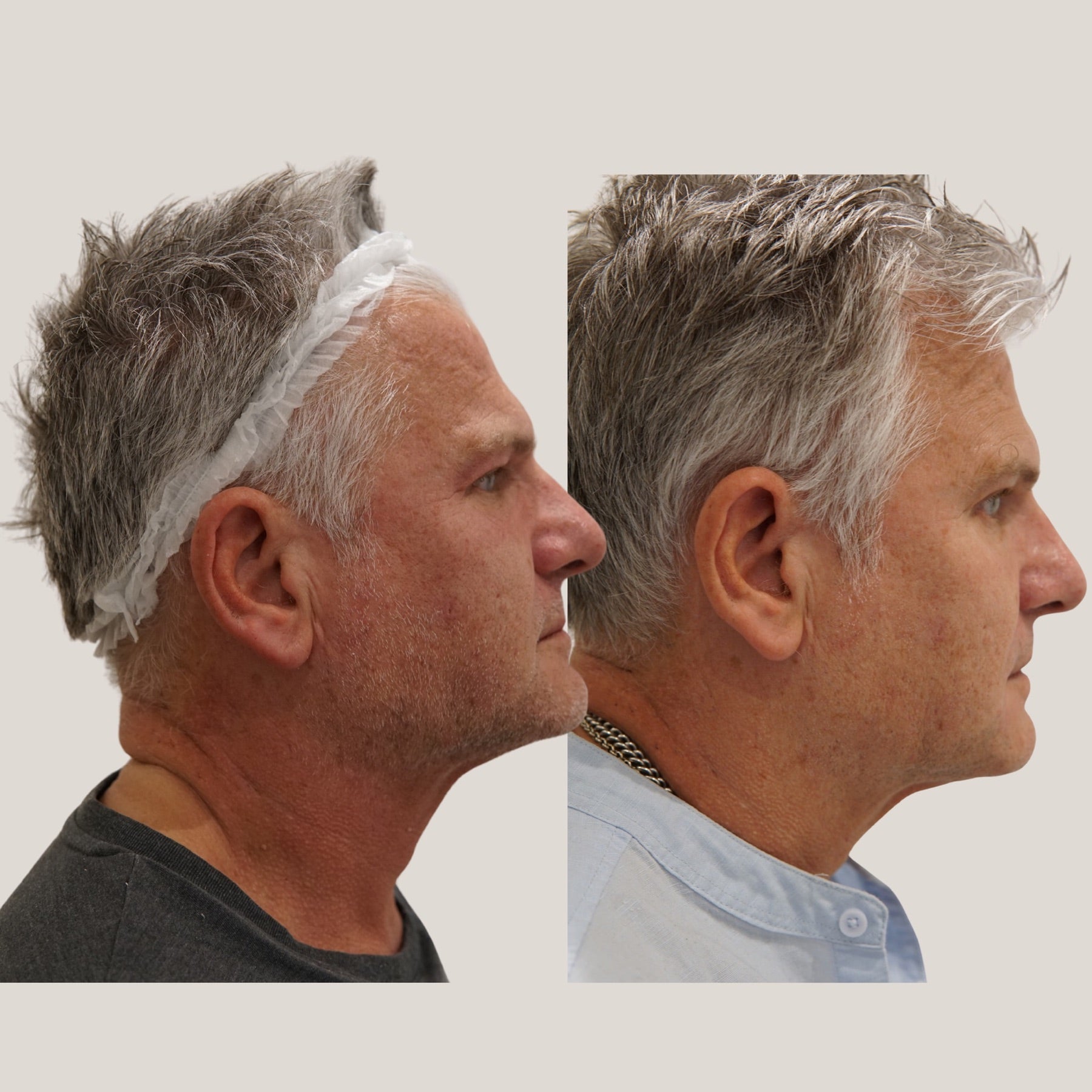 Origin Glass Laser Day 0 to Day 30 side profile rejuvenation comparison.