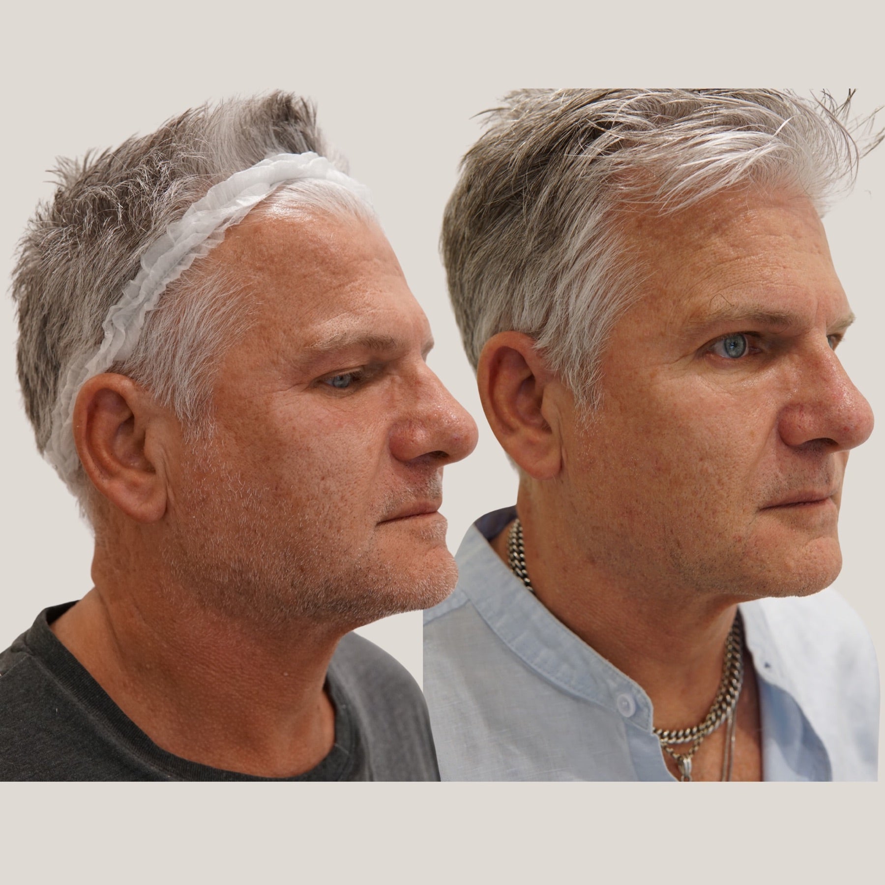 Origin Glass Laser Day 0 to Day 30 right-side rejuvenation comparison.