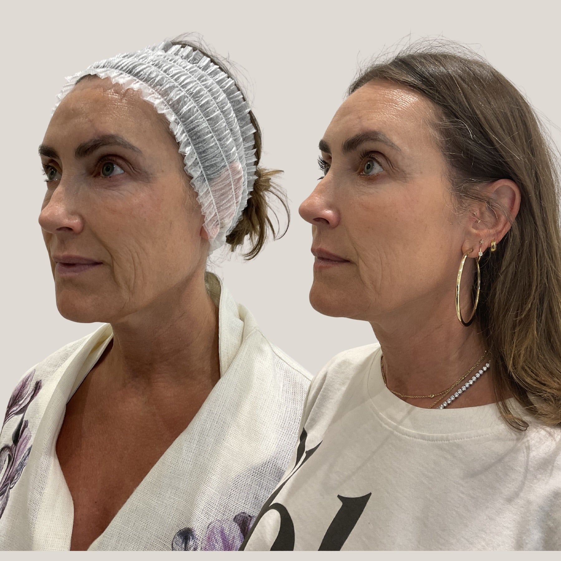 Origin Glass Laser Day 19 rejuvenation result angle four before and after.