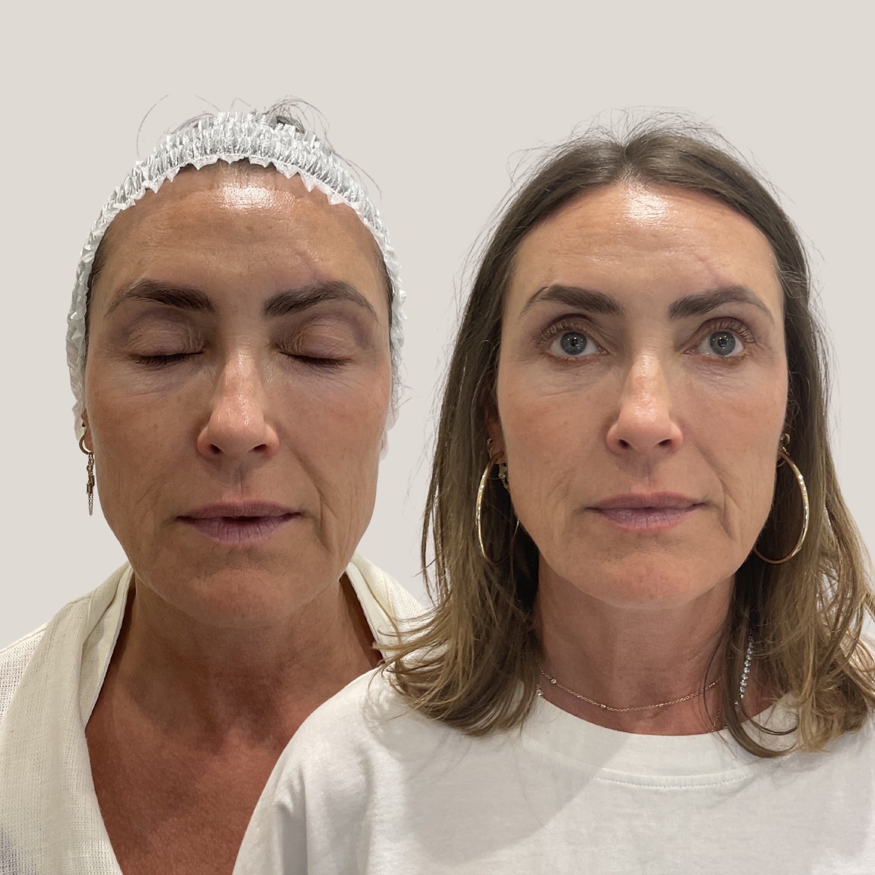 Dr Sknn skin rejuvenation before and after proof image