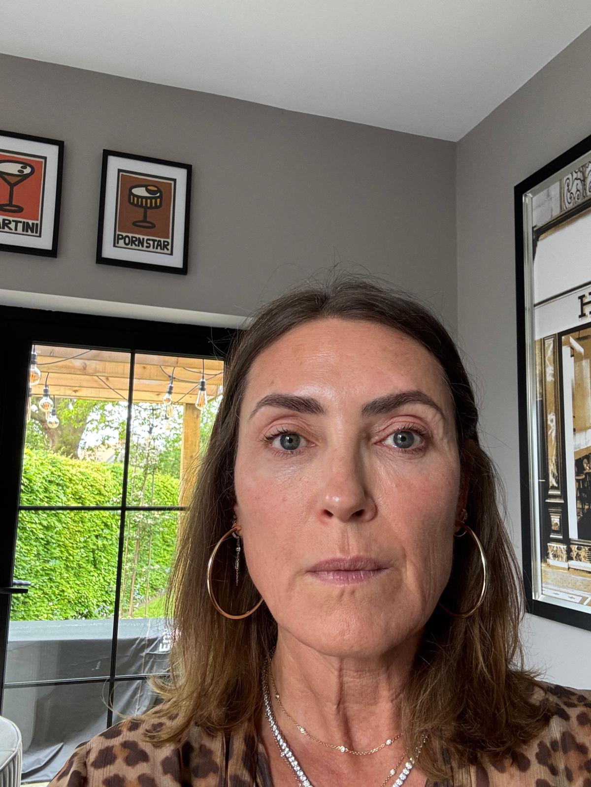 Origin Glass Laser Treatment 1 Day 2 recovery still image four after full-face treatment.