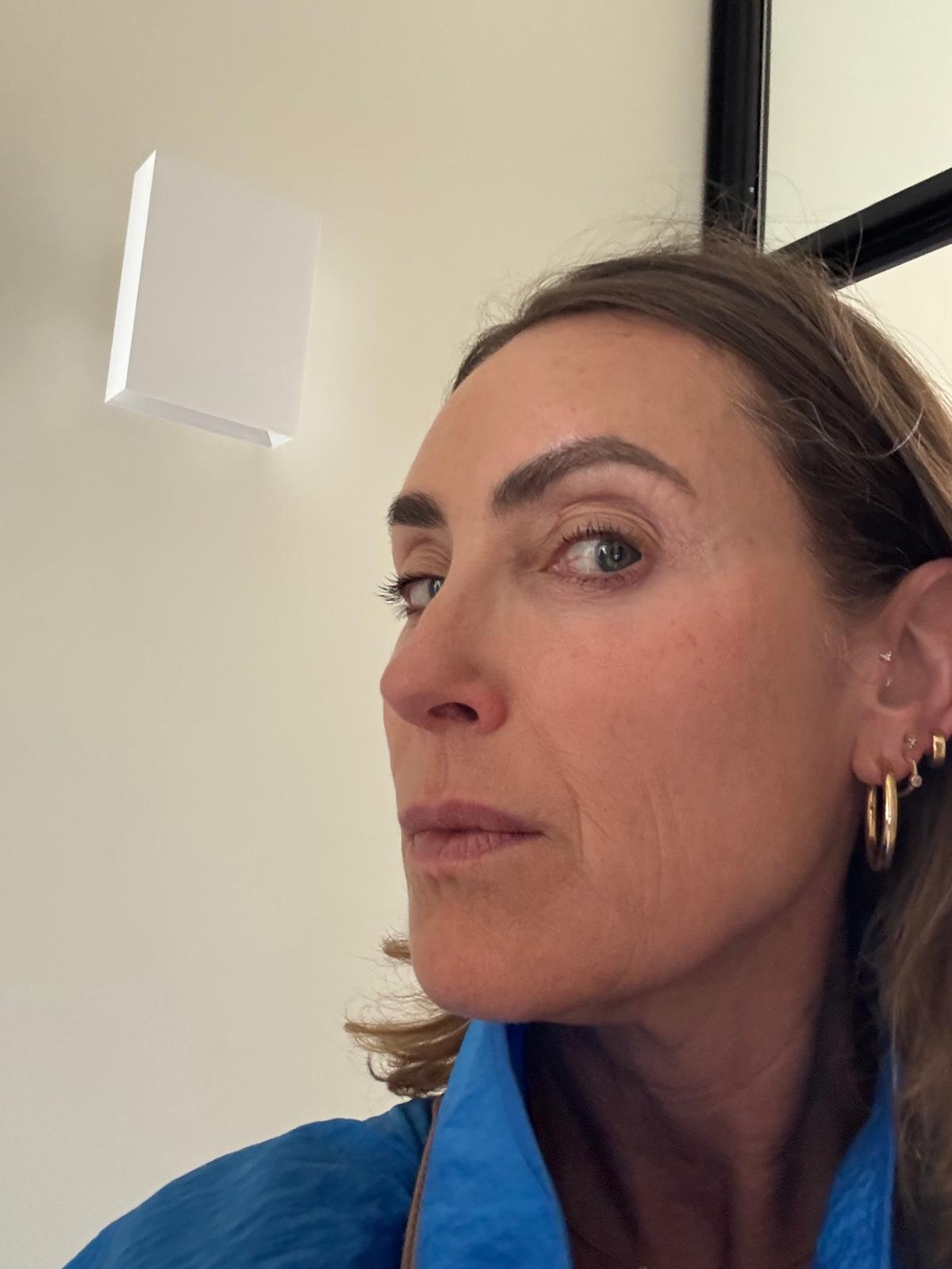 Origin Glass Laser Treatment 1 Day 4 recovery still image three after full-face treatment.