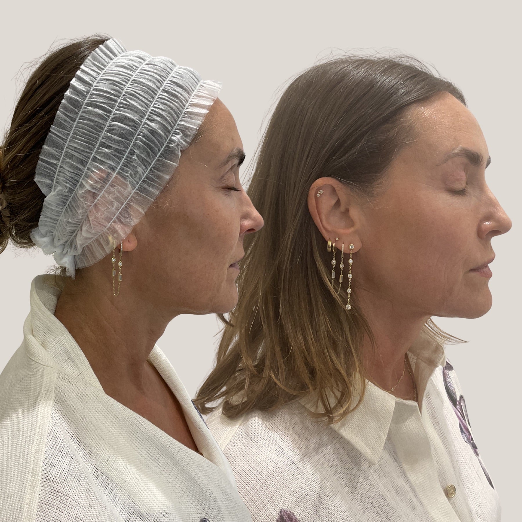 Origin Glass Laser visible freshness 2 hours post-treatment side-profile comparison.
