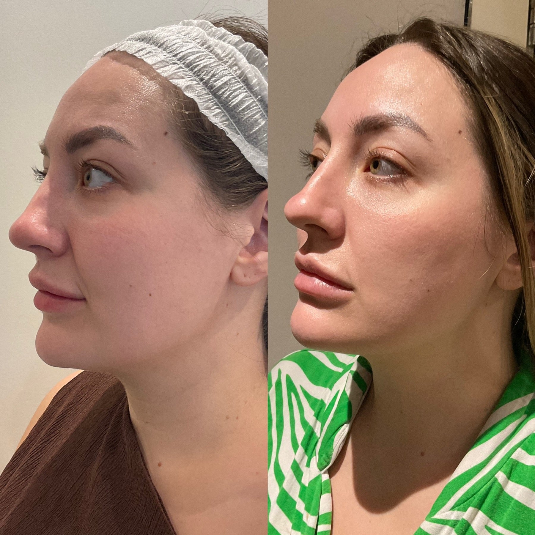 Origin Glass Laser visible freshness 4 hours post-treatment second-angle comparison for prejuvenation.