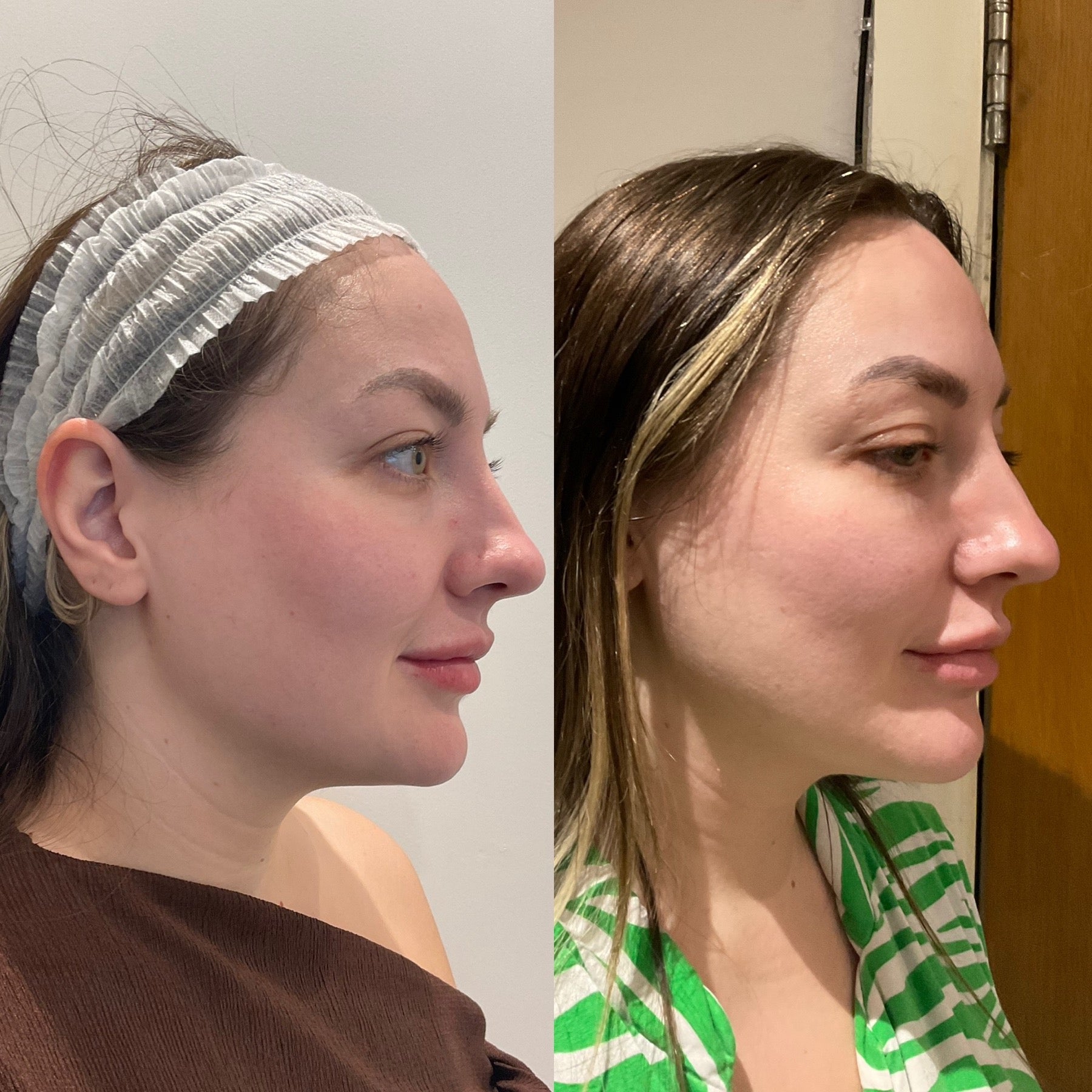Origin Glass Laser visible freshness 4 hours after treatment, profile comparison for prejuvenation.