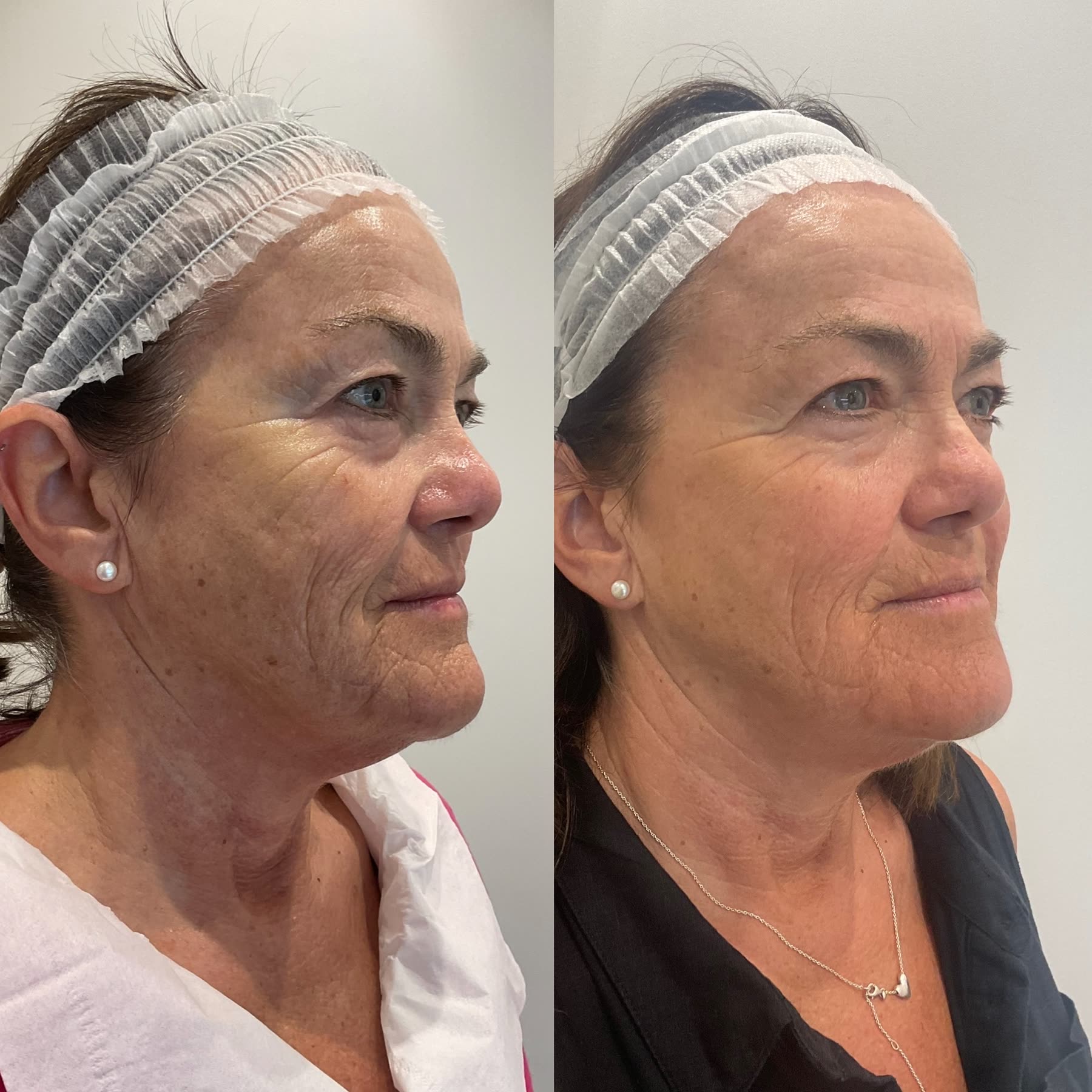 Origin Glass Laser full recovery journey Start to Day 76 second alternate angle comparison.