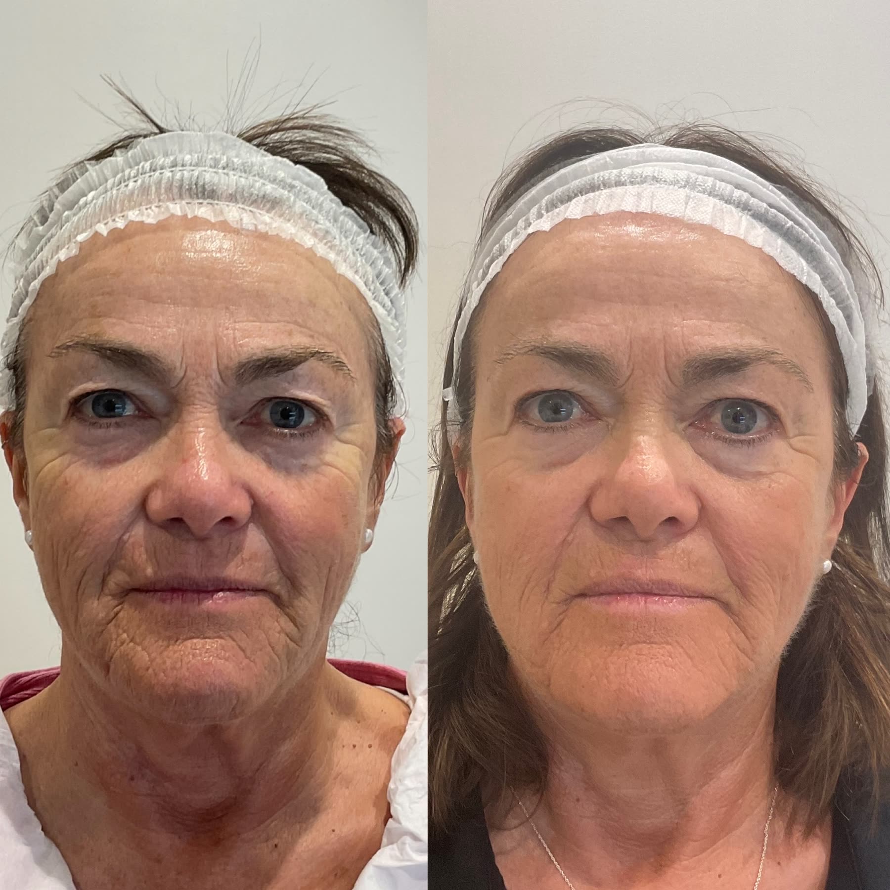 Origin Glass Laser full recovery journey Start to Day 76 alternate face and jawline comparison.