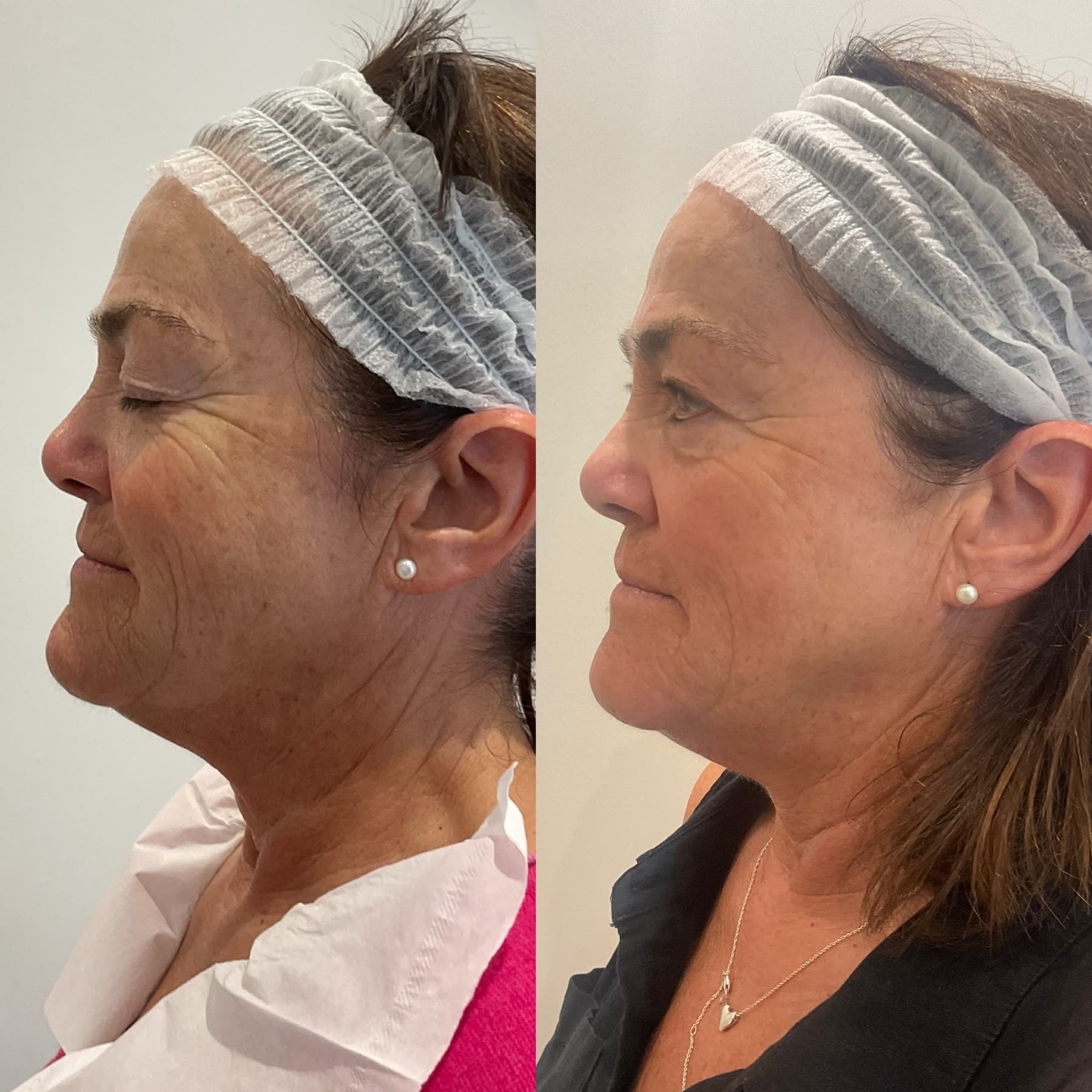Origin Glass Laser full recovery journey Start to Day 76 face rejuvenation comparison.