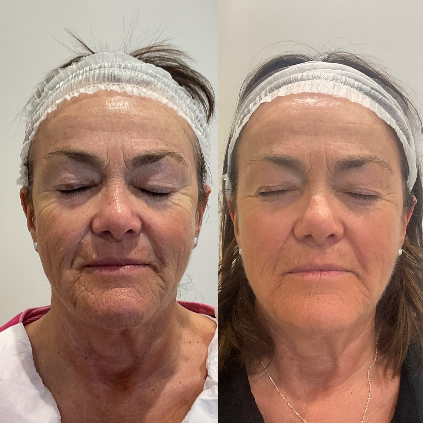Origin Glass Laser full recovery journey Start to Day 76 skin-quality comparison.